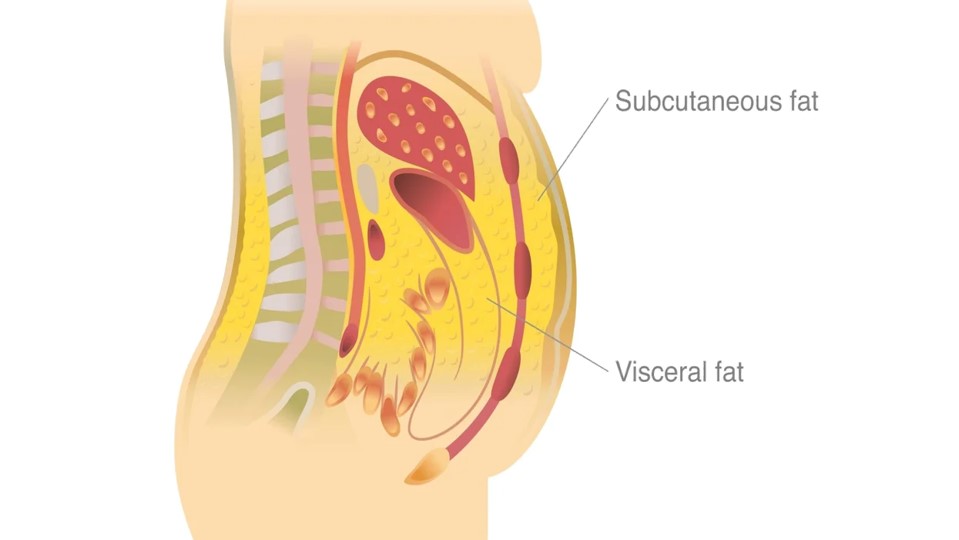 Subcutaneous Fat vs. Visceral Fat